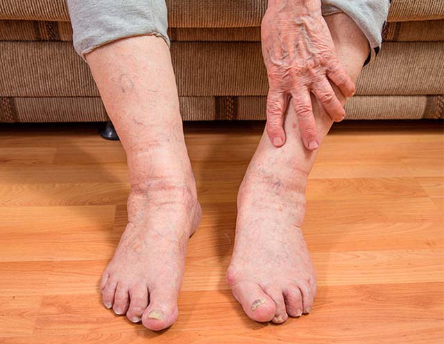 Лечение отека ног у пожилых женщин thumbnail