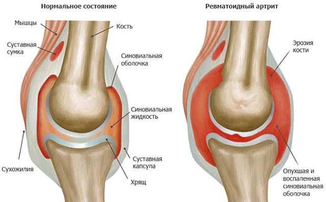 Лечение отечности ног у пожилых людей лечение thumbnail