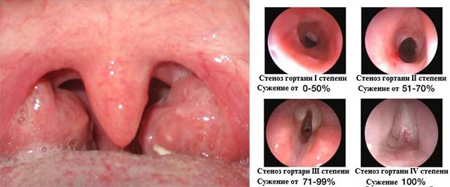 Воспаление язычка в горле при ангине thumbnail