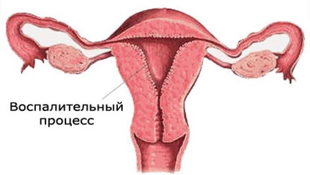 Накопление жидкости внутри матки