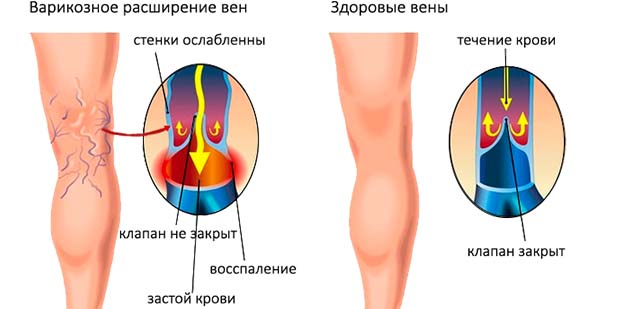 Отечность ног у пожилых женщин лечение thumbnail