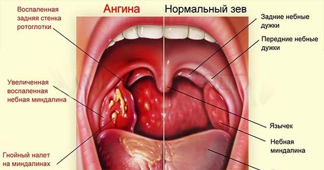 Воспаление язычка при ангине thumbnail