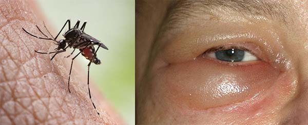 Аллергия на укус насекомых