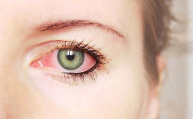 Аллергический отек глаза