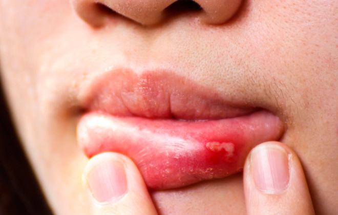 Что делать если раздуло губу аллергия thumbnail