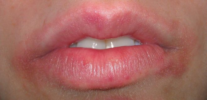 Аллергия на губах