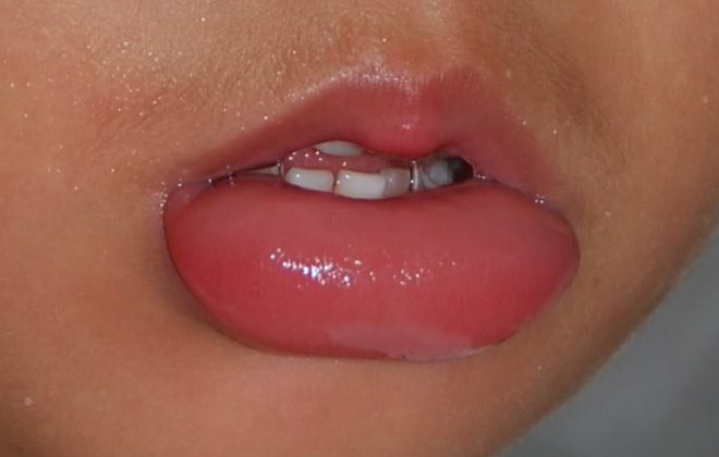 Ангионевротический отек губ