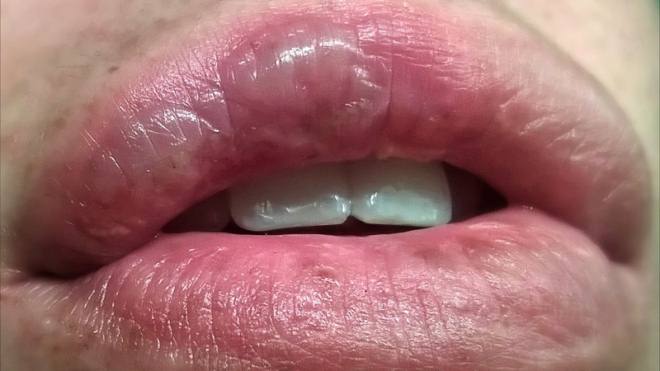 Снять аллергический отек с губ thumbnail