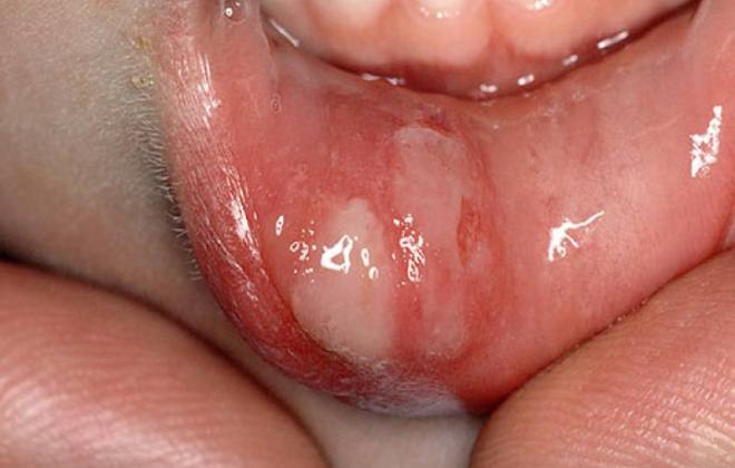 Аллергия губ с отеком thumbnail