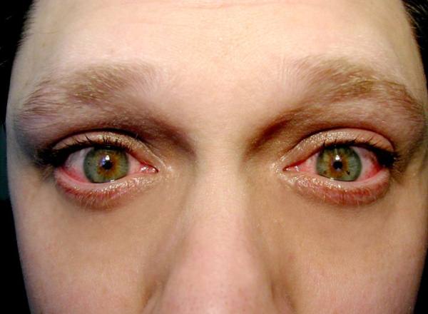Заболевание глаз блефарит