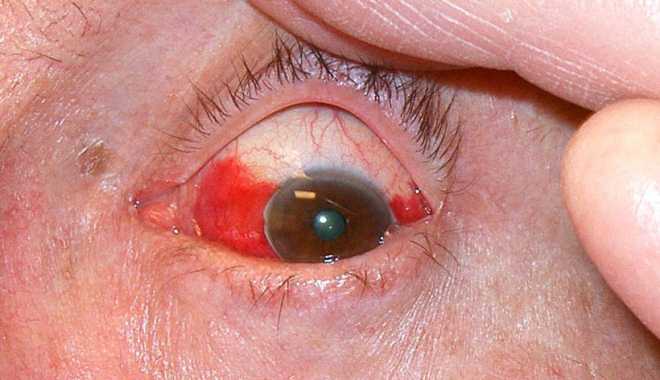 Лечение отека роговицы глаза после операции thumbnail