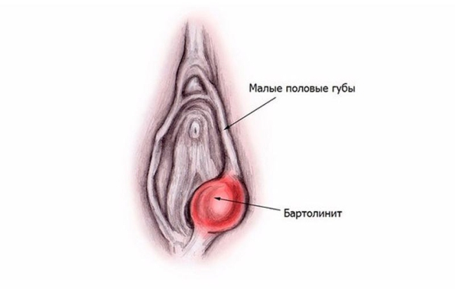 Гинекология отек половых губ thumbnail